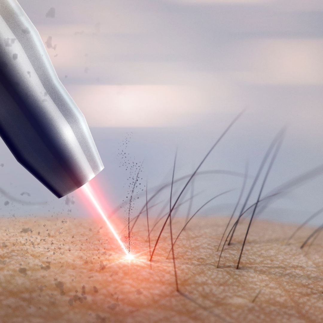 Lumin Beauty Lumix™ Permanent Hair Removal System - Product Details