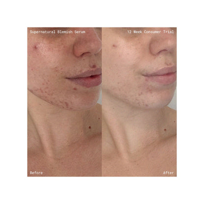 Emma Lewisham Supernatural Blemish Face Serum - Image 9