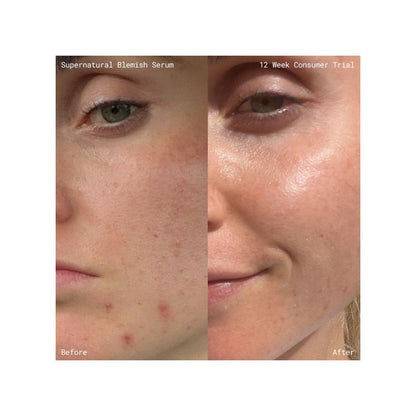 Emma Lewisham Supernatural Blemish Face Serum - Image 10